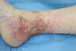 Ulcerierte Capillaritis alba